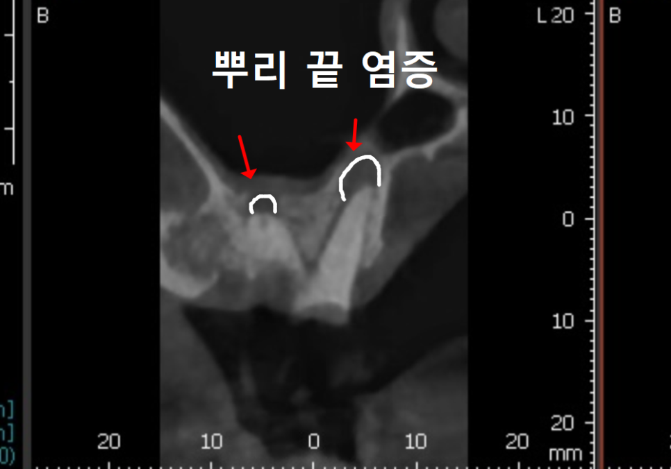 상일역 치과, 오래된 금니 빠짐, 같은 증상으로 내원했지만 전혀 다른 결과, 그 차이는? 관련 이미지 7