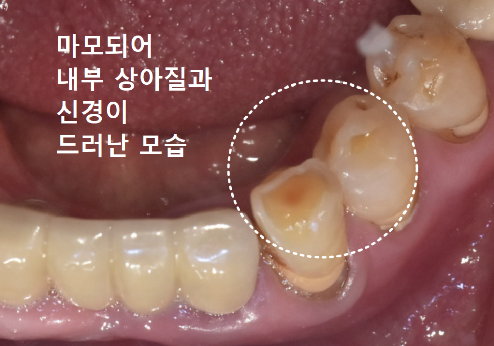 고덕역치과, 잇몸 패임(치경부 마모) 레진 치료, 왜 자꾸 떨어지나요? 관련 이미지 5