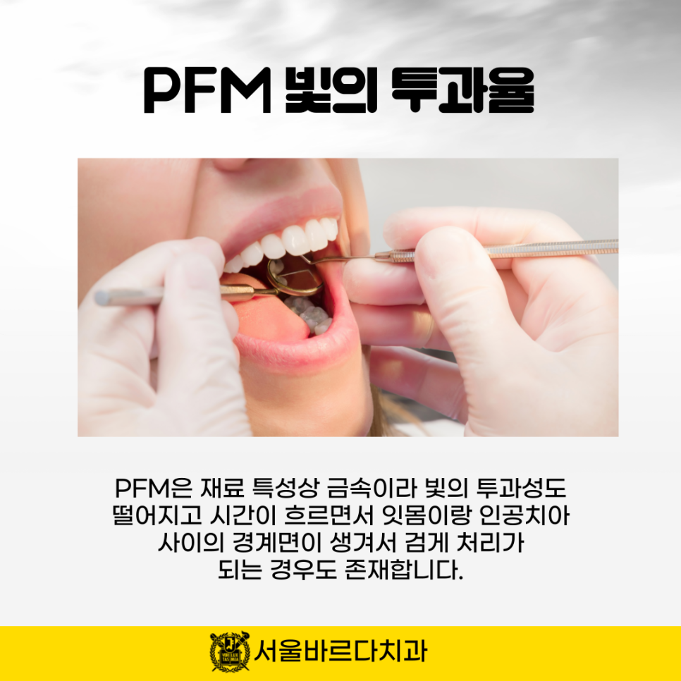 상일동치과 서울바르다치과, 다 똑같은 크라운인지 알았는데 지르코니아와 PFM의 차이를 알고계신가요~? 관련 이미지 7