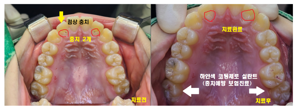 충치치료 레진 비용 이 금액이 맞나 궁금하신 분들을 위하여 관련 이미지 6