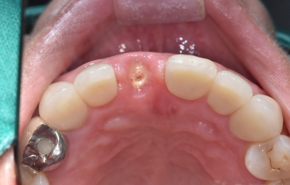 풍산동 임플란트 이 뽑고 임시틀니는 꼭 해야하나요? 플리퍼란? 관련 이미지 5