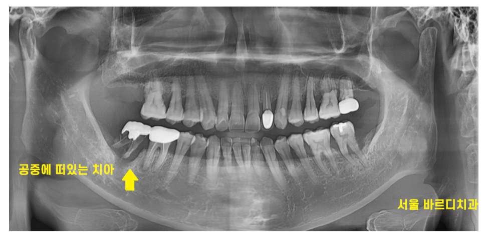 이 흔들림으로 발치 후 뼈이식 진행한 케이스 관련 이미지 2