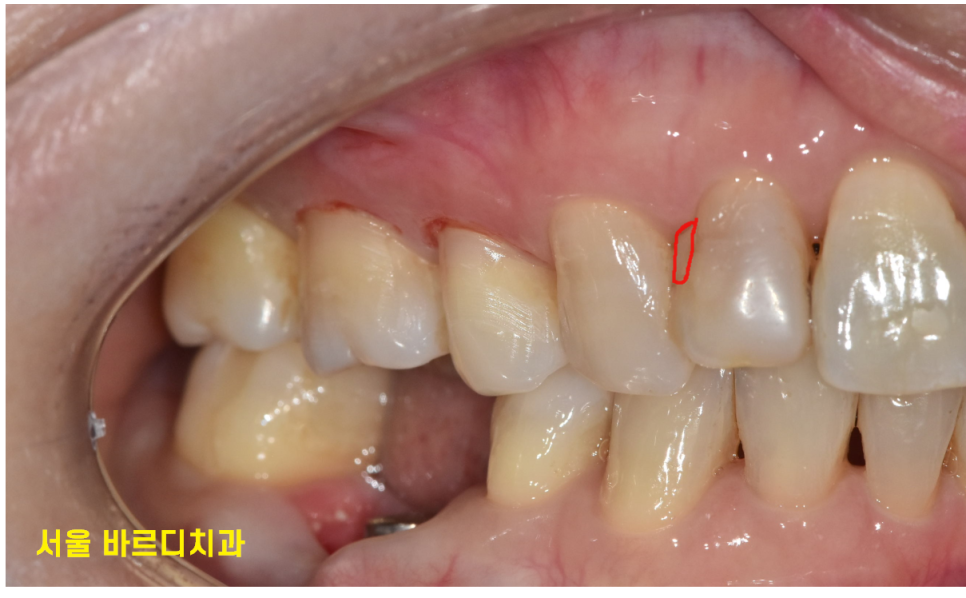 상일동역 라미네이트 치아 무삭제 정말 가능한가요? 관련 이미지 4