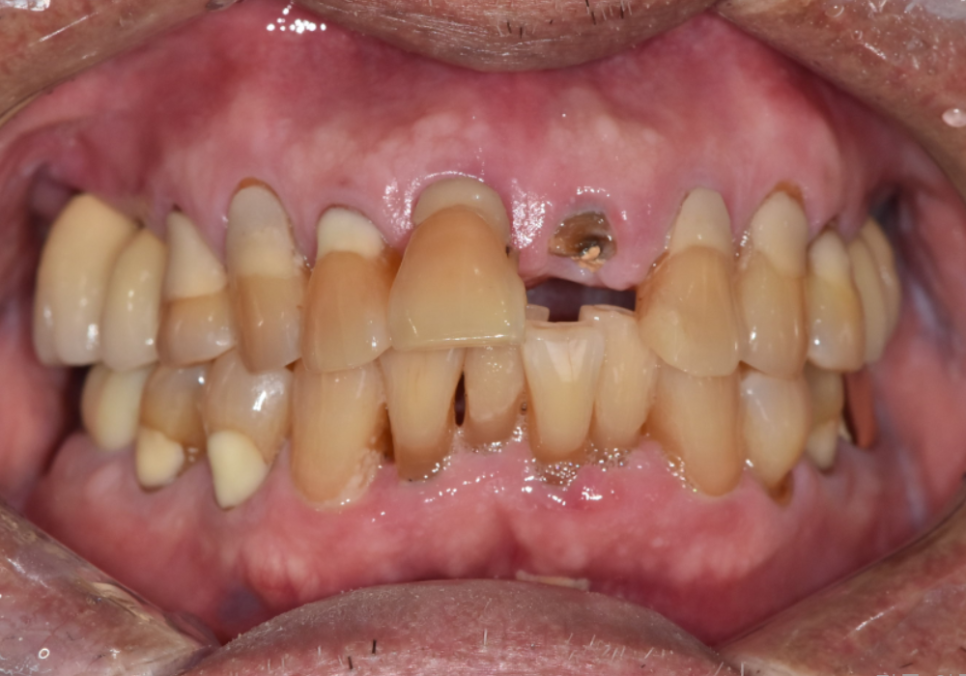 상일동역 치과 앞니 임플란트 기간 때문에 망설이신다면 꼭 보세요. 관련 이미지 1