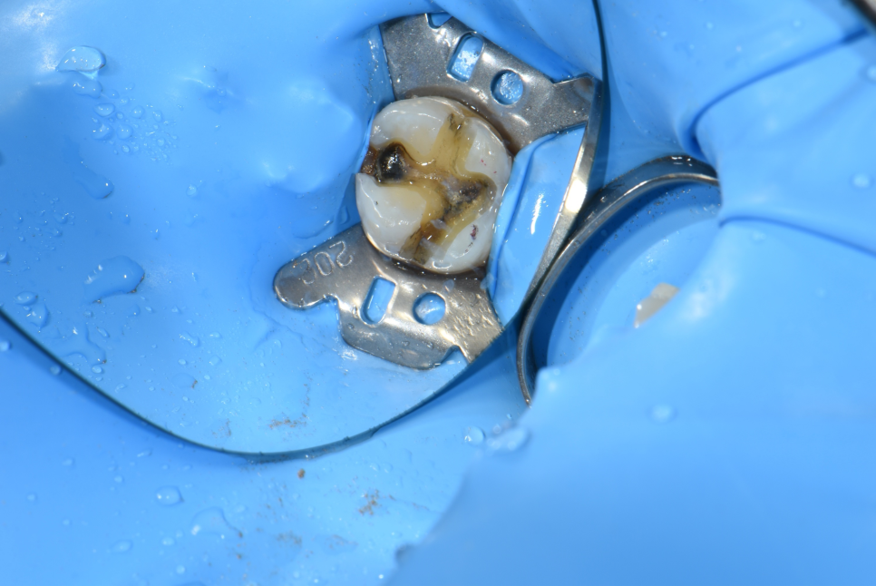 골드 인레이 하방 이차우식 => E.max 인레이로 재치료 케이스 관련 이미지 3