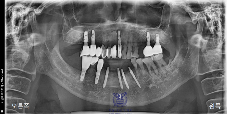 고덕동치과 서울바르디치과 전치부 및 구치부 임플란트 치료증례 #10 관련 이미지 10