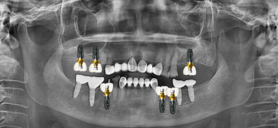 명일동 치과 임플란트 치료 기간 얼마나 걸릴까요??? 관련 이미지 5