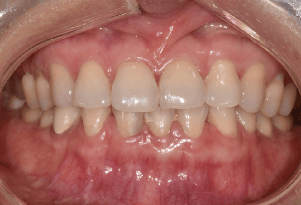 앞니 레진 떨어짐, 자꾸 반복된다면 관련 이미지 13