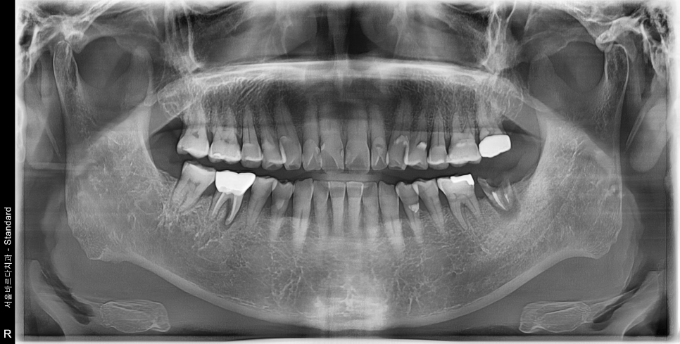 바르디 임플란트는 바르게 심지만, 빠르게 씹습니다. 그간의 경험을 바탕으로요. 관련 이미지 1
