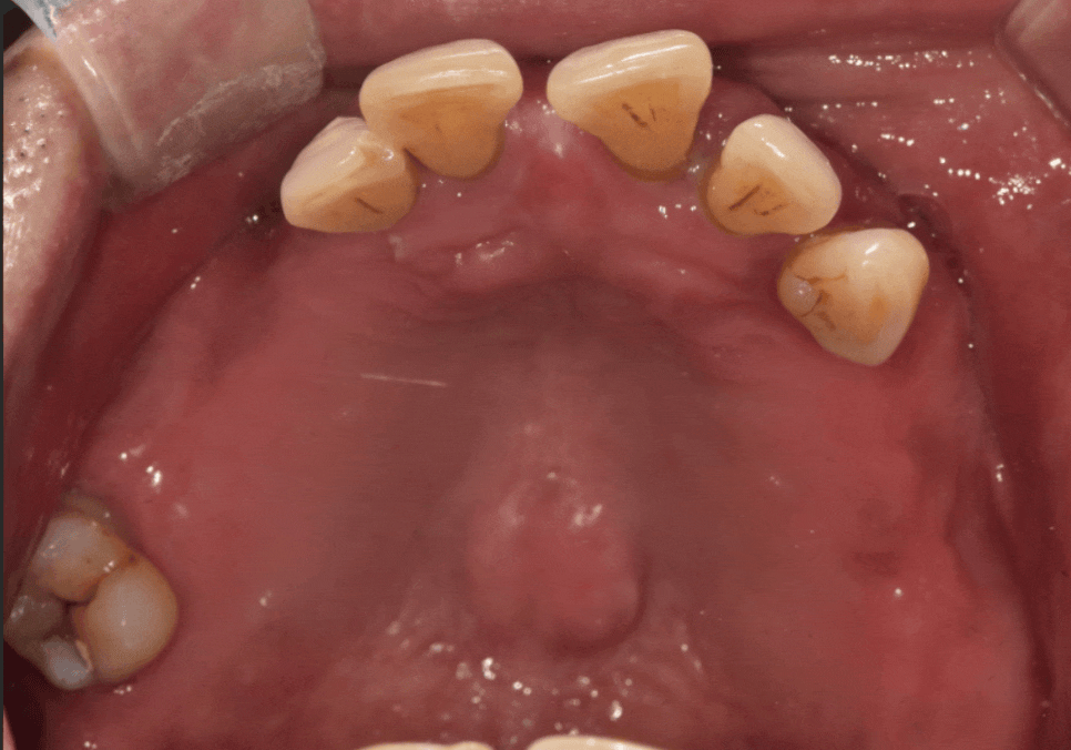 위 턱 전체 임플란트 vs 부분 틀니, 나에게 꼭 필요한 치료법 찾기 관련 이미지 17
