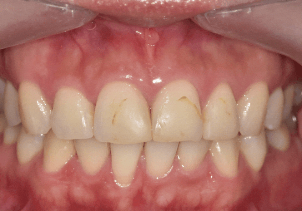 강일역 치과, 검게 보이는 앞니 레진 변색, 무조건 새로 해야 할까요? 관련 이미지 4