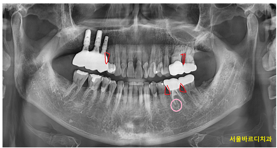 잇몸 곪음 피가 나오고 치통이 있을 때 관련 이미지 2