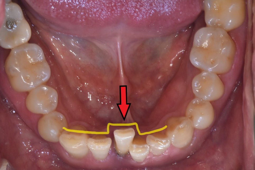 My Teeth Are Shaking So Much That Eating Is Uncomfortable—Is It Okay to Just Leave Them Alone? image 5