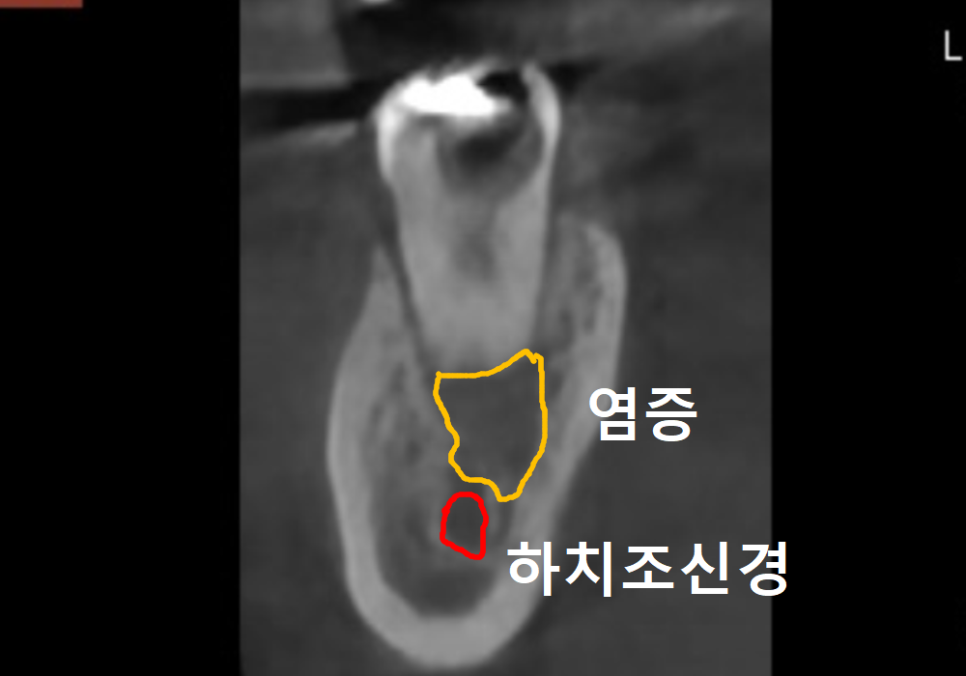 고덕동 어금니 사이 충치, 양치질 누구보다 열심히 하는데 왜 자꾸 생길까요? 관련 이미지 11