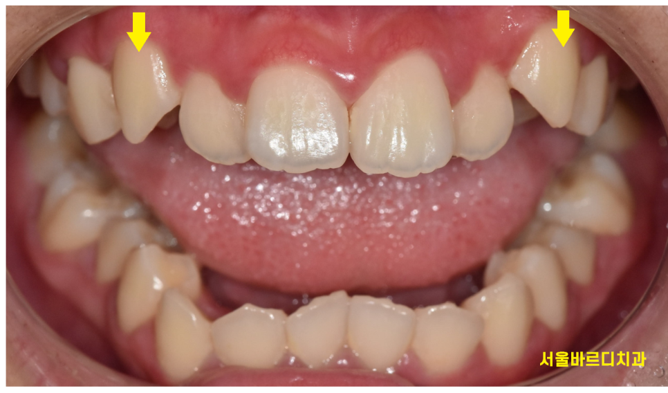 강동구 교정치과 교정 꼭 해야하나요??? 관련 이미지 4