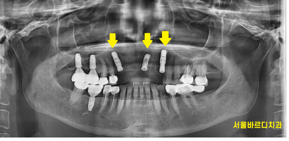 상일동 치과 충치로 인한 앞니 브릿지 파절 재건해보았습니다. 관련 이미지 7
