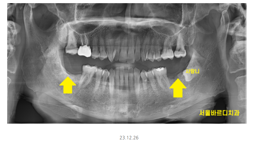 하남시청치과 내비게이션 임플란트 뭐가 좋아요?? 관련 이미지 2