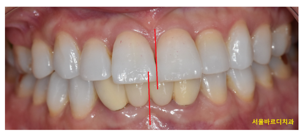 치아 중심선 안맞을 때 걱정스러우신 분들이라면? 관련 이미지 2