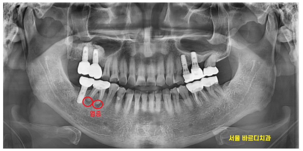 미사역 임플란트 잇몸이 풍선처럼 부풀어오르는 치주농양 환자분 관련 이미지 2
