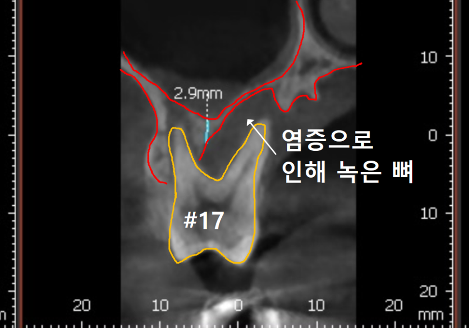 상악동 거상술 부작용 걱정되시나요? 재수술 없는 뼈이식의 정석 공개 관련 이미지 8
