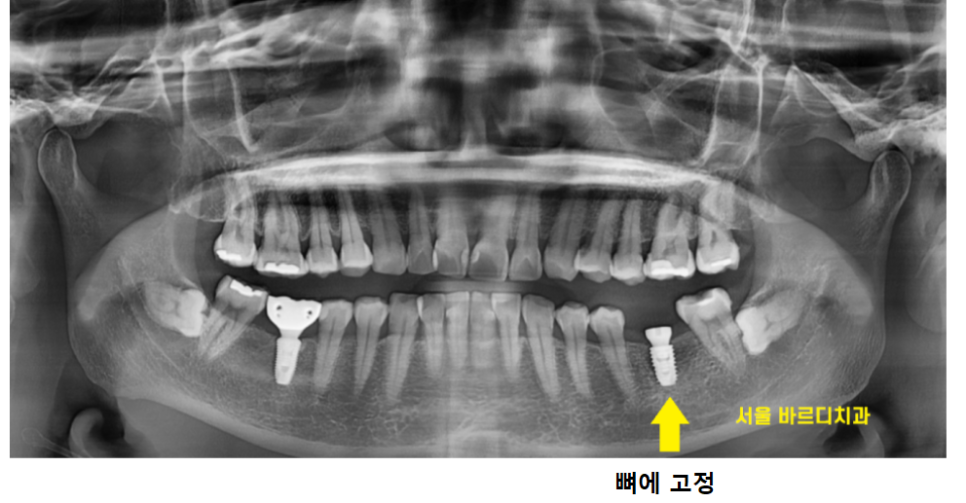 고덕역 근처 치과 임플란트 크라운 크기 크면 다 좋을까요?? 관련 이미지 7
