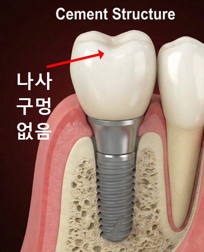 고덕 치과, 임플란트가 흔들려요. 뽑아야 할까 봐 고민이라면? 이렇게 해결합니다. 관련 이미지 6