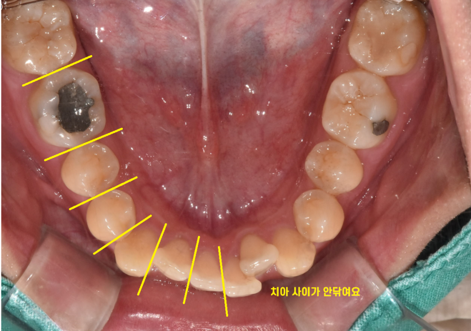치실 안쓰면 이렇게 됩니다!!  치아 사이 충치 인레이 치료 관련 이미지 2