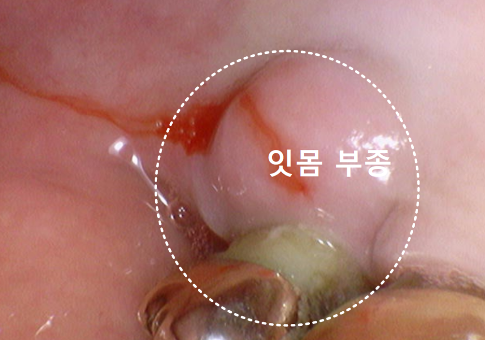 강동구 잇몸 퇴축으로 뿌리 드러난 치아, 이대로 둬도 괜찮을까? 관련 이미지 6