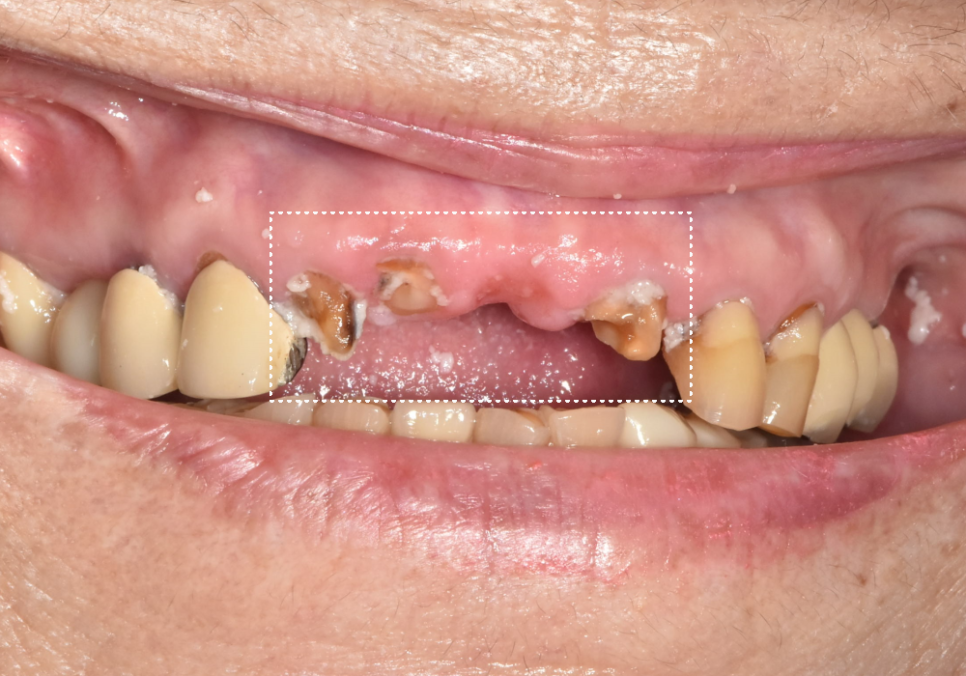 상일동 임플란트 심한 충치로 인한 치아 부러짐 해결한 사례 관련 이미지 4