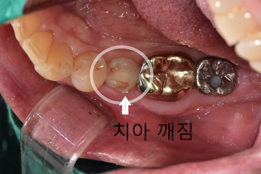 아침에 일어날 때 어금니가 욱신거린다면? 이 습관을 의심해 봐야 합니다. 관련 이미지 3