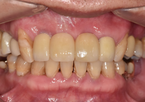앞니 흔들림, 임플란트 치아보험 감액 기간 넘기려다 더 큰 손해 봅니다. 관련 이미지 11
