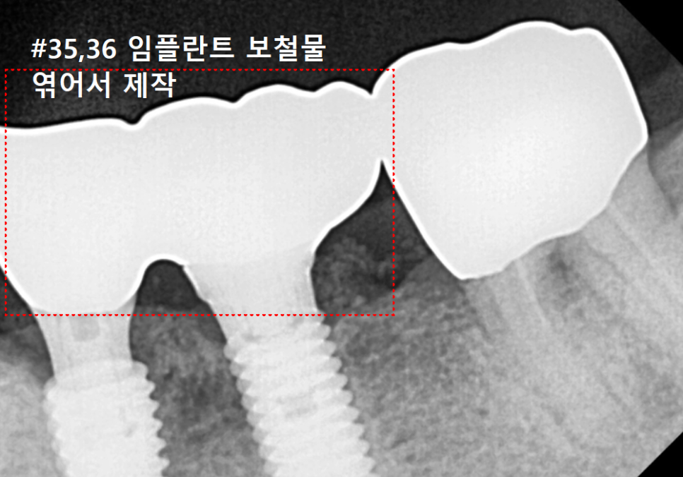 상일역 임플란트, 음식물 끼는 이유, 처음엔 안 그랬는데 왜 점점 심해지는 걸까요? 관련 이미지 11