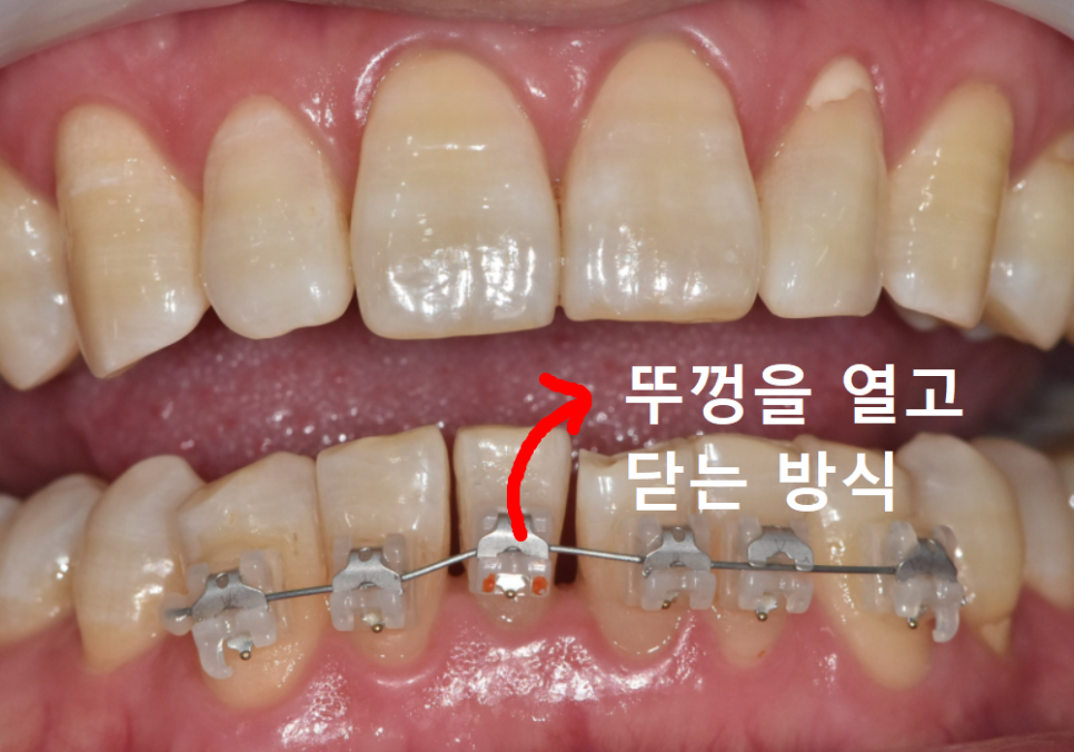 명일역 앞니 부분 교정, 치아 하나만 삐뚤어져 보인다면? 굳이 전체 교정할 필요 없습니다. 관련 이미지 5