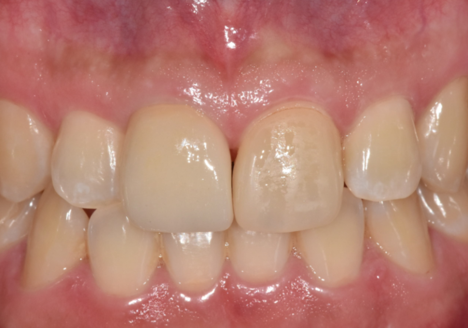 앞니 라미네이트 교체, 재시술 전 꼭 알아야 할 실패를 줄이는 방법 관련 이미지 12