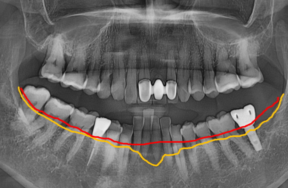 솟구치는 앞니, 흔들리는 치아가 보내는 관련 이미지 8
