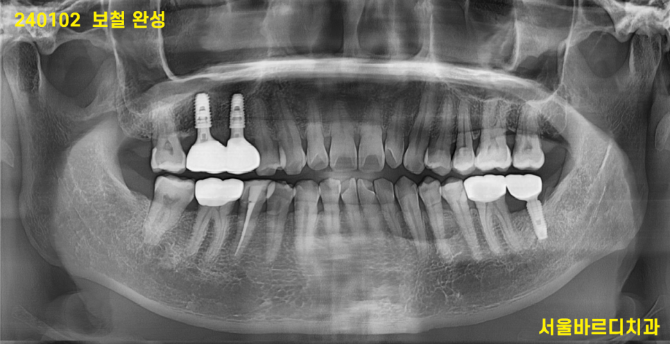 고덕동 치과 잇몸 주저앉음 느낌이 들었다면 늦었을 수도 있습니다. 관련 이미지 11