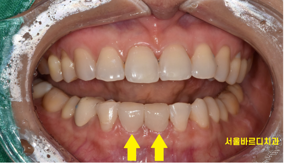 고덕동 치과에서 시행한 라미네이트와 치아 미백 과정 및 순서 관련 이미지 7