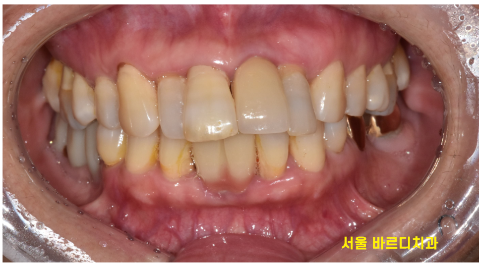 상일동역 치과 윗니 앞니 흔들림 임플란트로 심미까지 잡았습니다. 관련 이미지 2