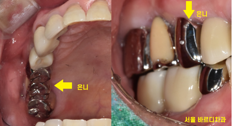고덕동 치과치료 씌운 치아 문제가 생겼어요 관련 이미지 3