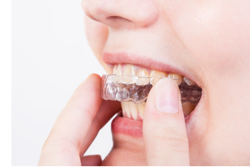 Godeok Station Dental Clinic: If You’re Considering Starting Adult Clear Aligners, Click image 2