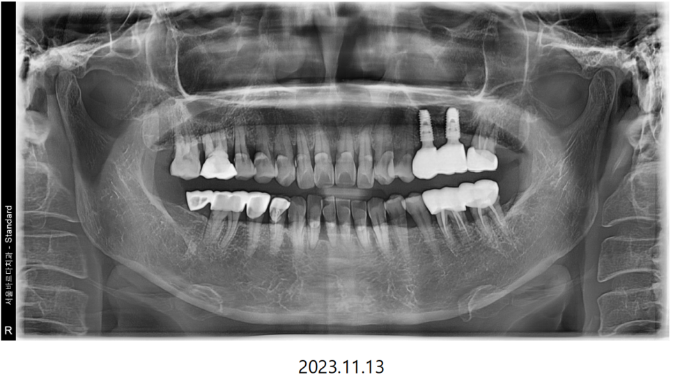 고덕동치과 서울바르디치과 무절개 네비게이션 임플란트 치료증례 #2 관련 이미지 20