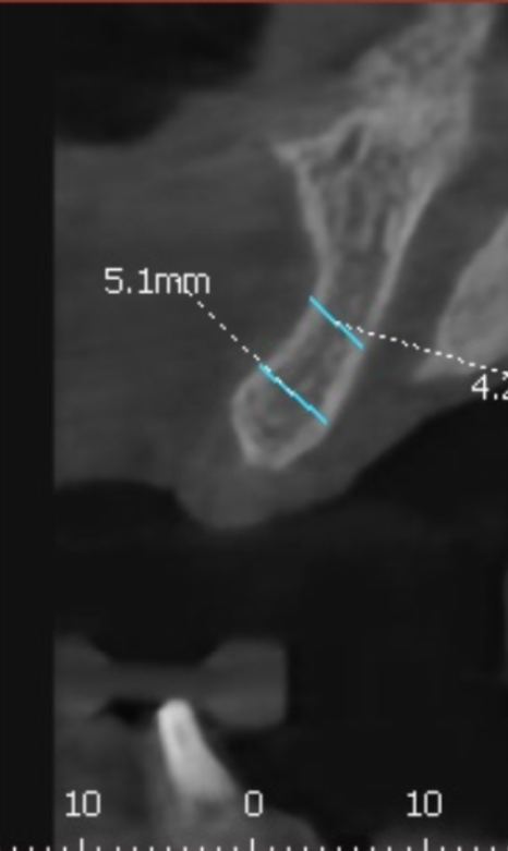 앞니 브릿지 부러짐, 이런 상태라면 절대 브릿지 다시 하지 마세요. 관련 이미지 11