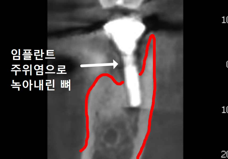 오래된 임플란트, 흔들림과 통증, 어떻게 하면 더 건강하게 쓸 수 있을까? 관련 이미지 6