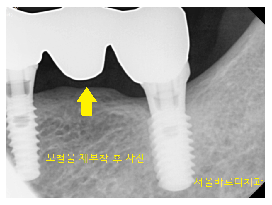 덕풍동 치과 오래된 임플란트 제거 후 재식립하였습니다. 관련 이미지 3