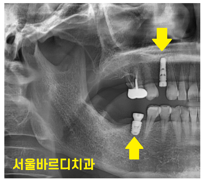 고덕동 치과 발치 후 방치하면 치아 쓰러짐 발생해요 관련 이미지 7