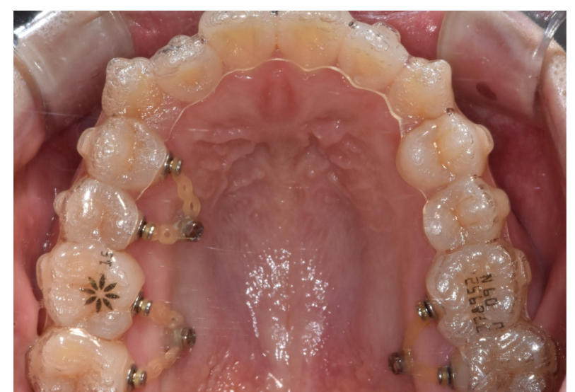 고덕동 투명교정은 발치 안 한다? 그건 오해입니다 관련 이미지 3