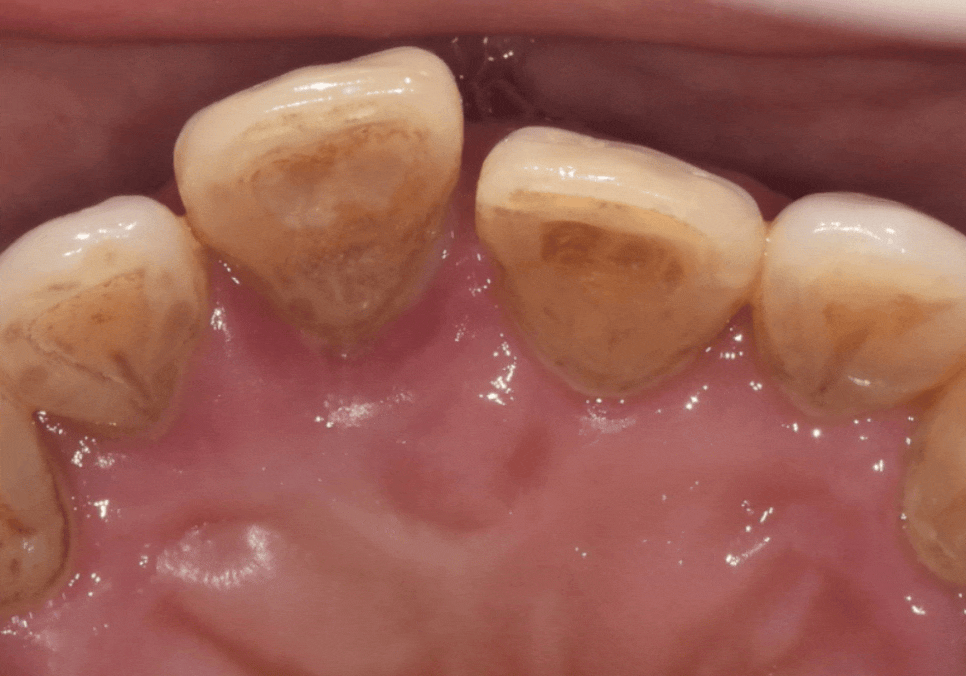 앞니 길어짐, 위 앞니가 점점 내려온다면? 관련 이미지 4