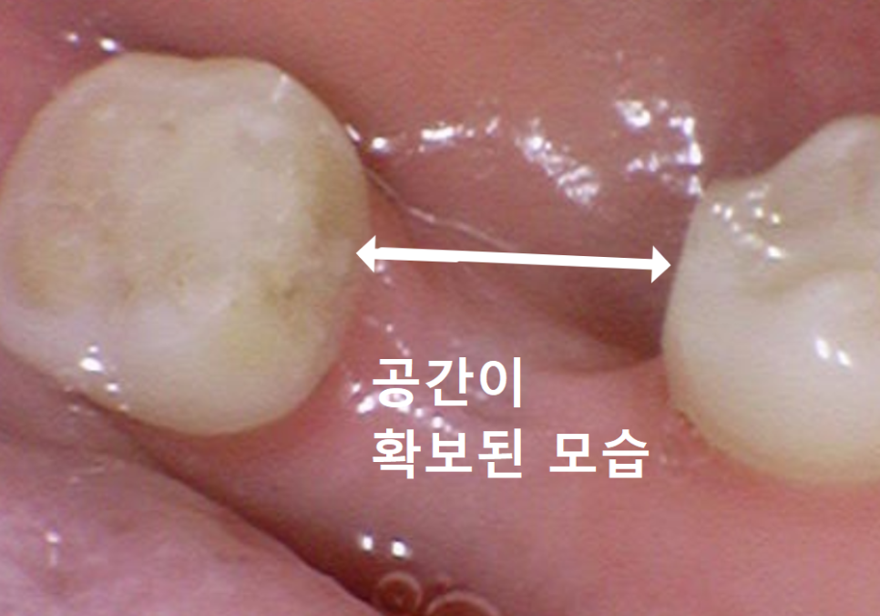 No space for an implant because a tooth has fallen over or a molar has tilted? Read this first. image 10