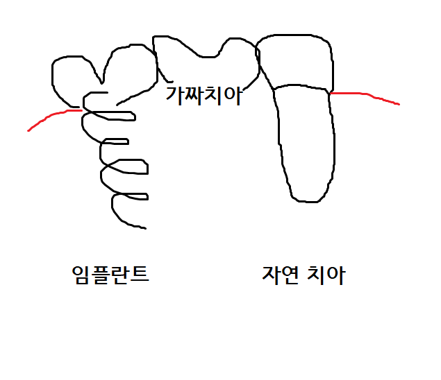 강일역 치과 치아와 임플란트 연결 가능한가요??? 관련 이미지 5