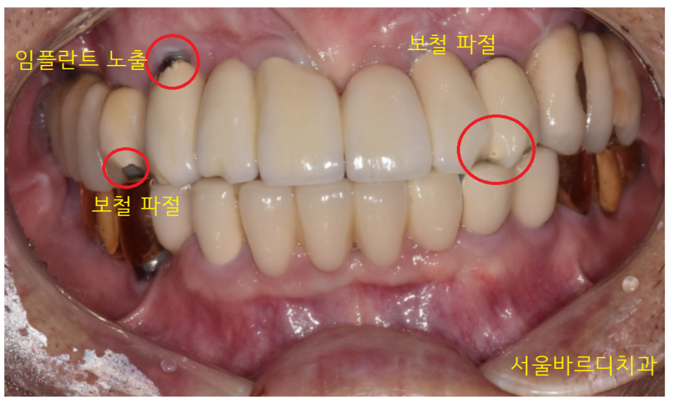 덕풍동 치과 오래된 임플란트 제거 후 재식립하였습니다. 관련 이미지 4